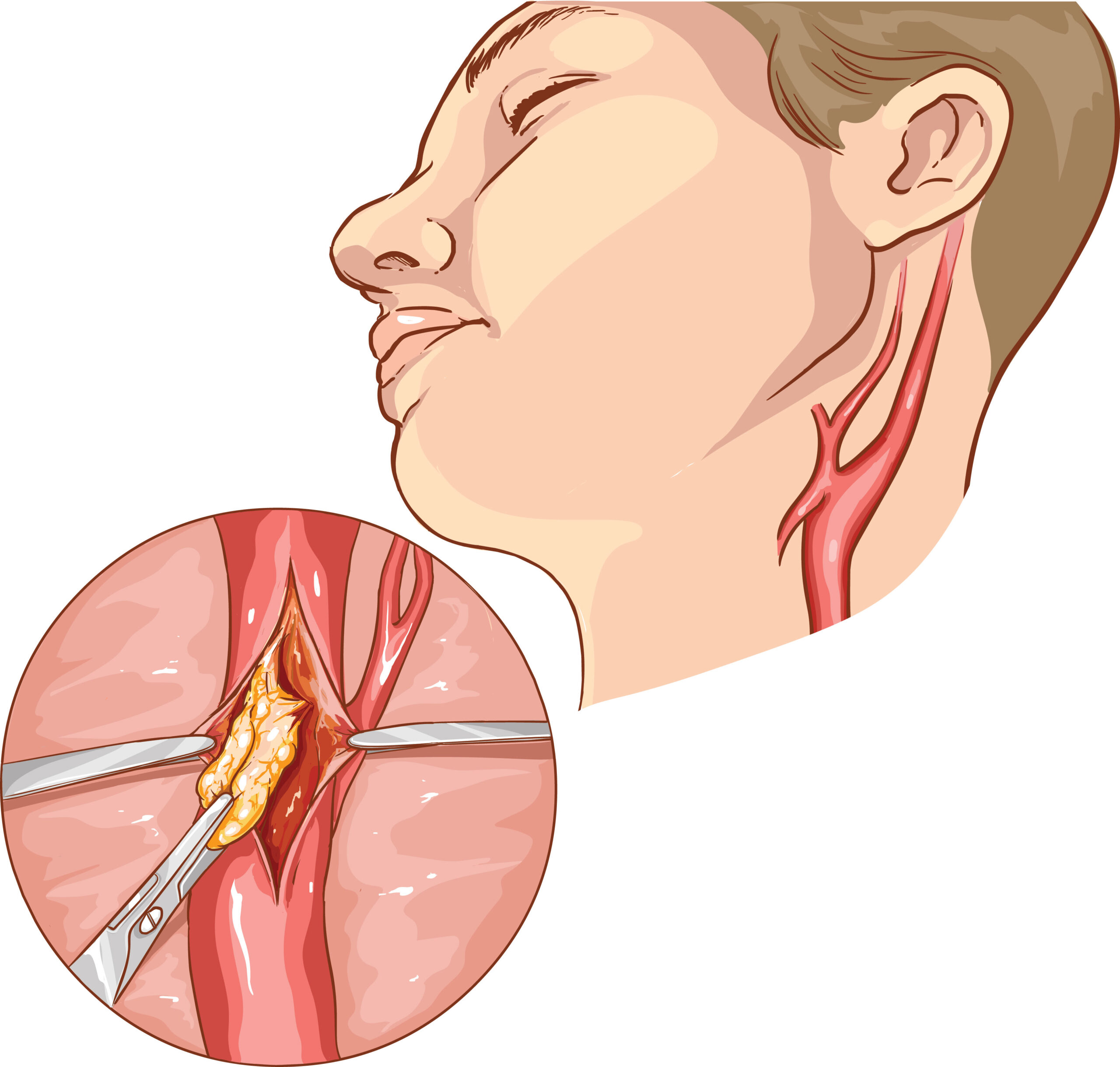 aneurysms idaho falls