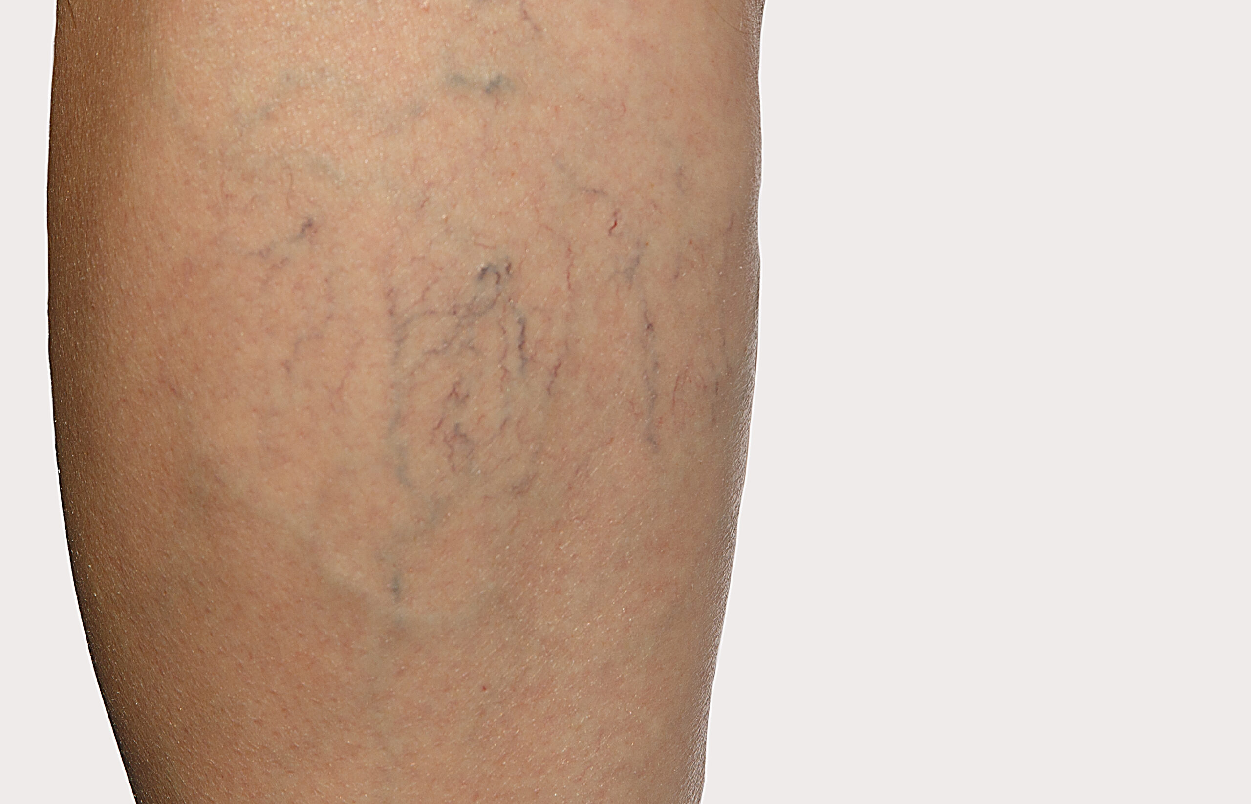 Do I Need a Referral for Varicose Veins?